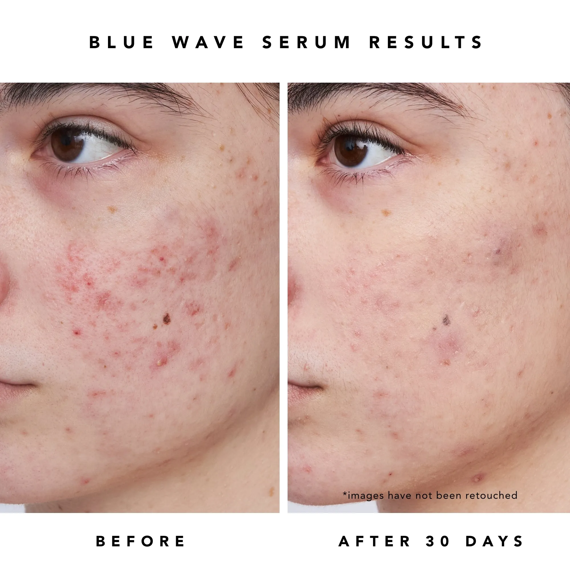 BLUE BESTIES Skin Clarity Set
